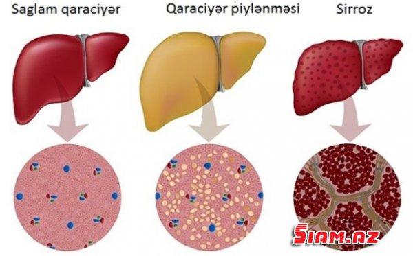Tibbdə yenilik: Qara ciyərin bərpası artıq mümkün olacaq Tibbdə yenilik: Qara ciyərin bərpası artıq mümkün olacaq
